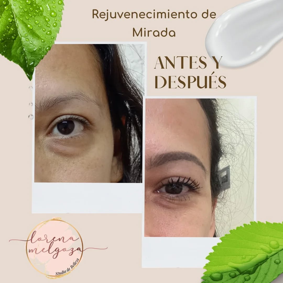 Resultado antes y después de rejuvenecimiento de mirada