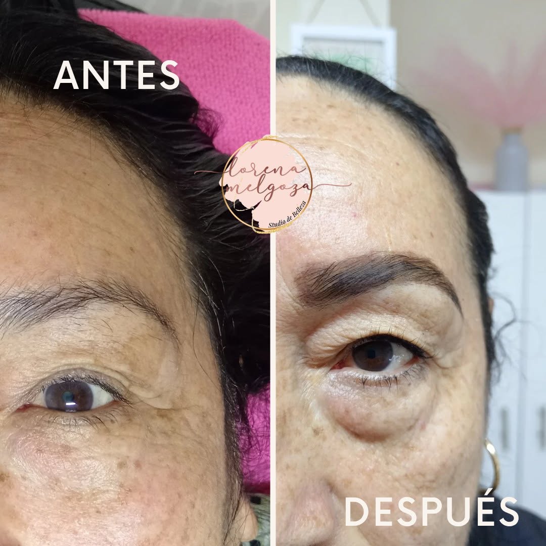 Antes y después de tratamiento de rejuvenecimiento de mirada